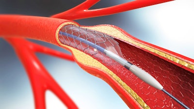 Tekni Plex Catheter Stent